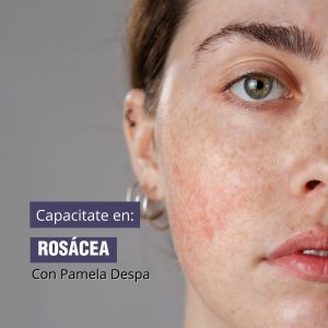 Tratamiento para Rosácea